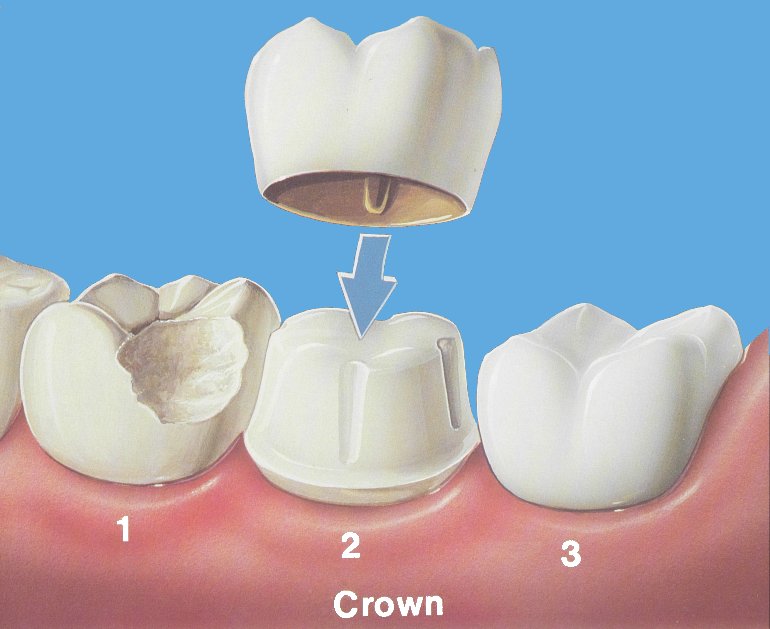 Dental Crowns in Charlotte | Cosmetic Dentist Information